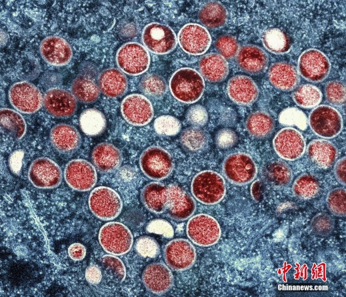 當(dāng)?shù)貢r間2022年7月26日，美國馬里蘭州，在實(shí)驗(yàn)室培養(yǎng)的感染細(xì)胞(棕色)中發(fā)現(xiàn)的猴痘顆粒(橙色)的彩色透射電子顯微圖。圖片來源：視覺中國