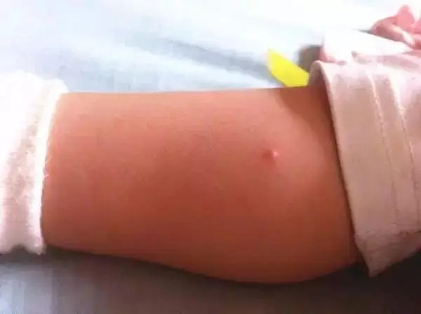 孩子起水痘是什么引起的？都有哪些症状