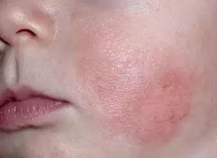 宝宝患了湿疹如何护理 5大注意事项要牢记
