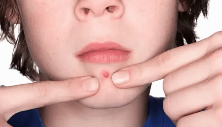 你还在挤痘痘？警惕！用手挤“痘痘” 引发败血症