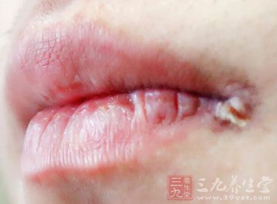 中醫(yī)認(rèn)為，口角炎是秋燥引起的，預(yù)防也應(yīng)將重心放在潤燥上